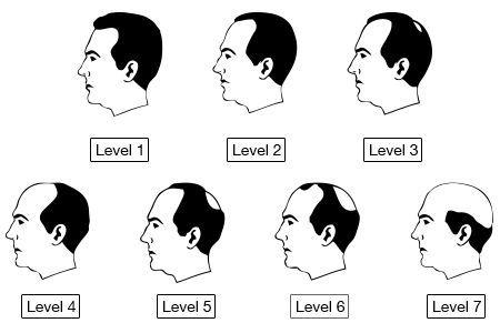 best hair transplant clinic in delhi